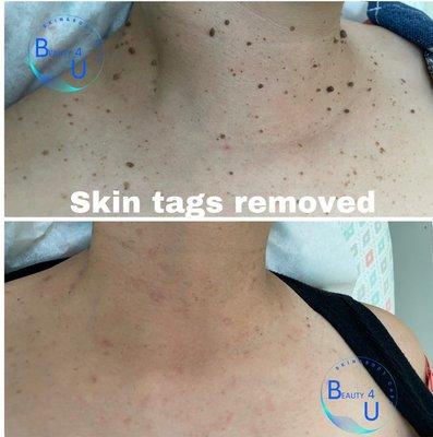 Skin tag removal. A few days after. Call/text for appointment.