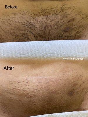 Brazilian Wax