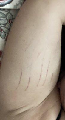 My right inner arm after my surgery at Lovelace Women's Hospital in Albuquerque, NM.  The blood pressure cuff squeezed my arm.