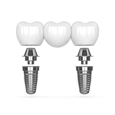 Multi-Tooth Dental Implants