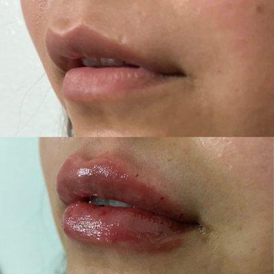 Before and after of lip filler treatment