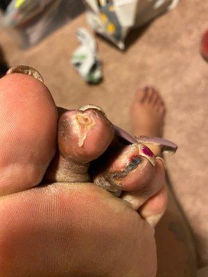 My infected toes finally healing