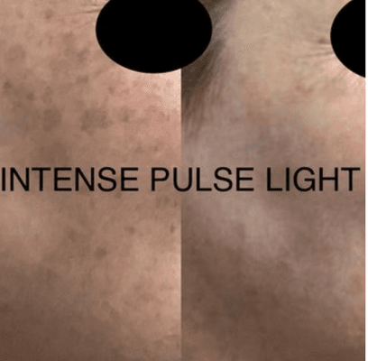 Intense Pulse Light