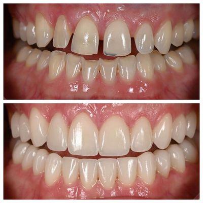 Dental Veneers