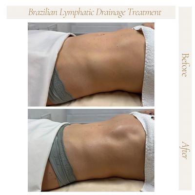 Lymphatic Drainage