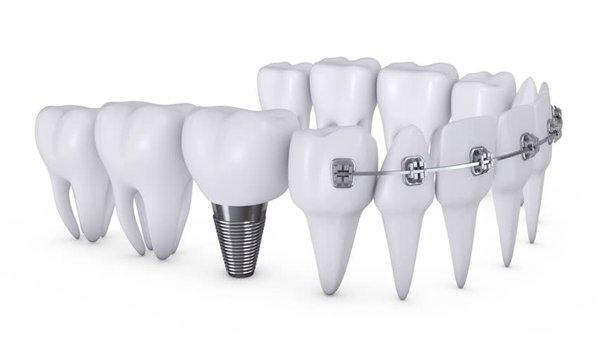 Dental Implant