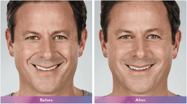 Look more vibrant and a little younger with dermal fillers and Botox injectsion.