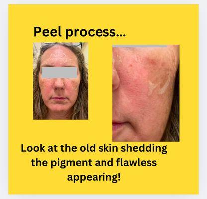 Peel process ... old skin shedding with the pigment and flawless skin appears