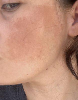 After chemical peel, One week Results.