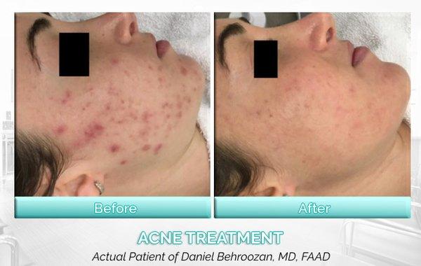 Keeping acne under control can be difficult. Patients have access to a variety of options from Dr. B., such as microneedling and lasers.