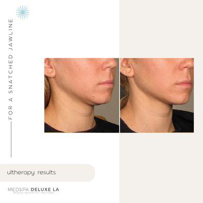 Ultherapy for skin tightening under the chin for a more defined jawline