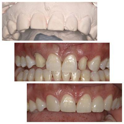 Porcelain veneers on lateral incisors