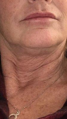 My neck after surgery