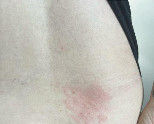 First sign of rash on lower back.