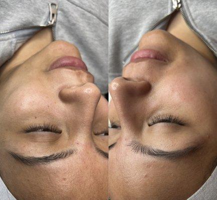 Dermaplaining Facials