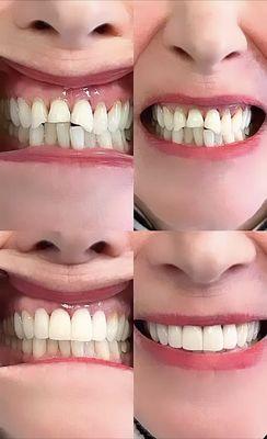 Another smile transformation at Laguna Dental