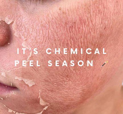 Chemical Peel season