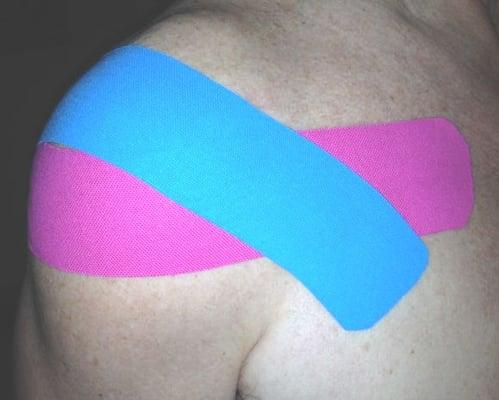 Kinesiotaping to support a painful shoulder.