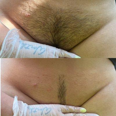 Brazilian wax