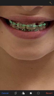 1 year with braces Phase 1 braces