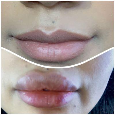 Lip fillers,  restylane kysse Before and After, by Connie