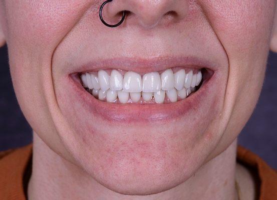 My new veneers