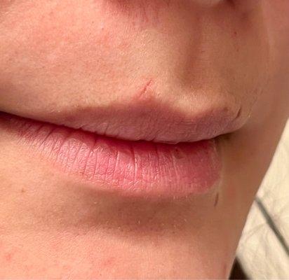 Left side of my cupids bow is where she nicked me while dermaplaning