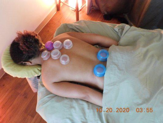 Cupping