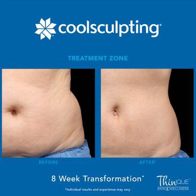 We offer CoolSculpting at our Practice!