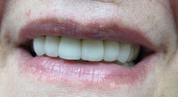 AFTER VENEERS