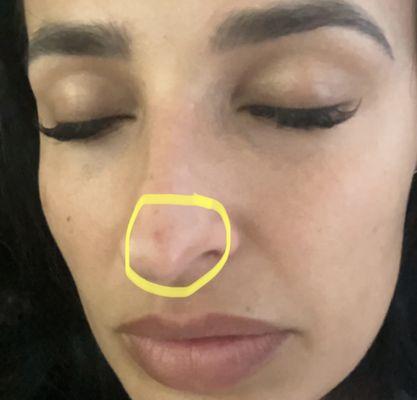 Broken capillary on my nose due to the over extraction during my Hydra facial. This is a current photo 9/21. April 19th date of service