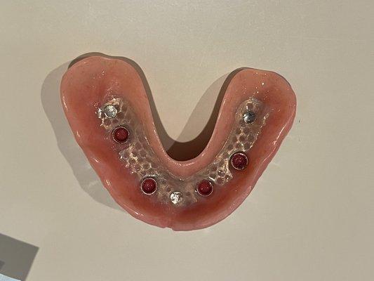 Implant supported dentures to regain your smile and function as well