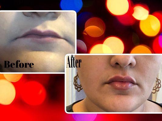 Lip fillers Juvederm