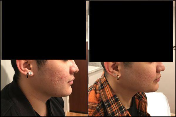 Microneedling - Before and After