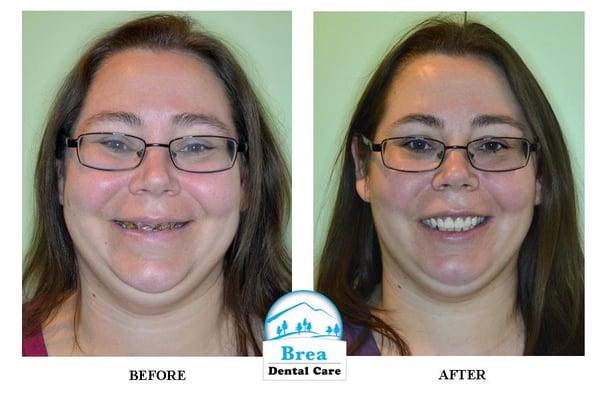 Our patient Lara. Before and After her smile makeover!