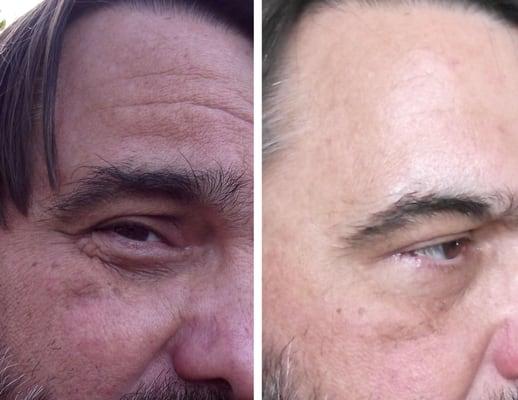 Terry's Photo Facial before and after.