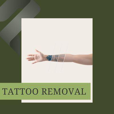 Tattoo Removal