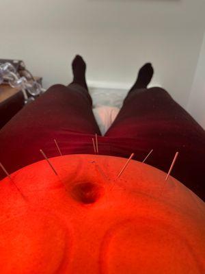 Acupuncture for fibroid and womb work!!!