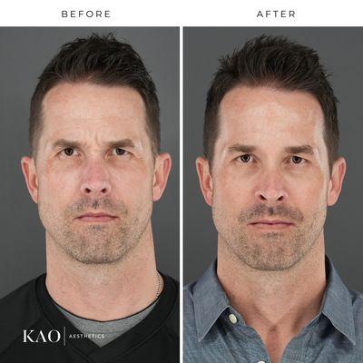 Before and after male neurotoxins - angry face