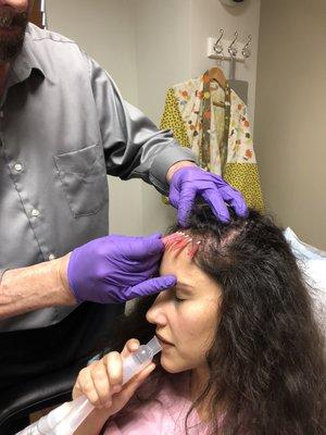 Threading for hair restoration with prp.
 Client using pronox machine for painless procedure!