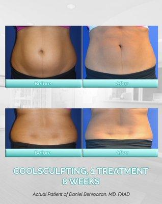 CoolSculpting can be used all over the body to reduce stubborn body fat. Results can be seen in as little as 8 weeks!