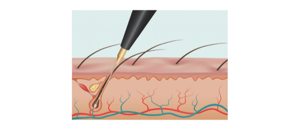 Electrolysis in action!