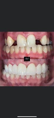 Before/After Smile Makeover