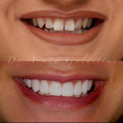 Smile makeover with 8 porcelain veneers