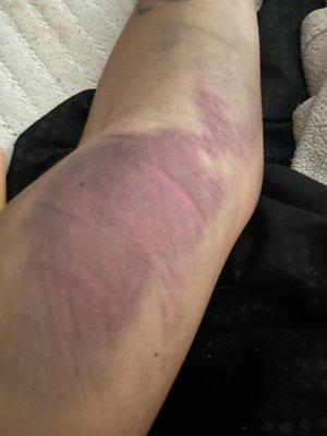 My arm after 2nd collapsed vein