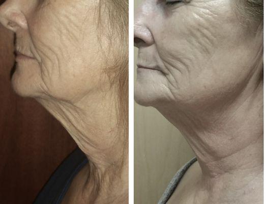 Sciton Profractional Laser after 60 days