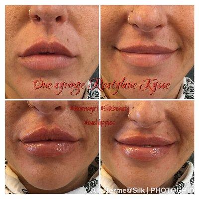 Restylane Kysse used on this lovely lady's lips.