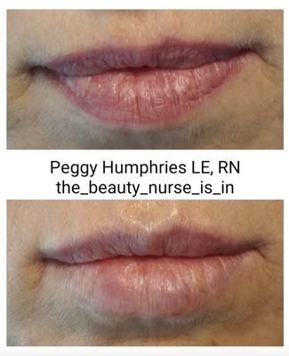 Lip Filler to enhance and restore shape and volume