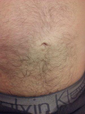 Abdomen AFTER