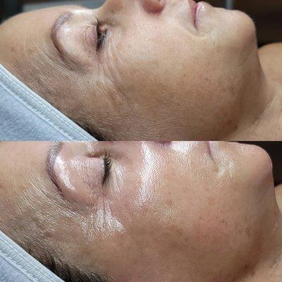 Anti aging ageless facial, firm, tightenes and lifts tired skin and photo pigmented skin